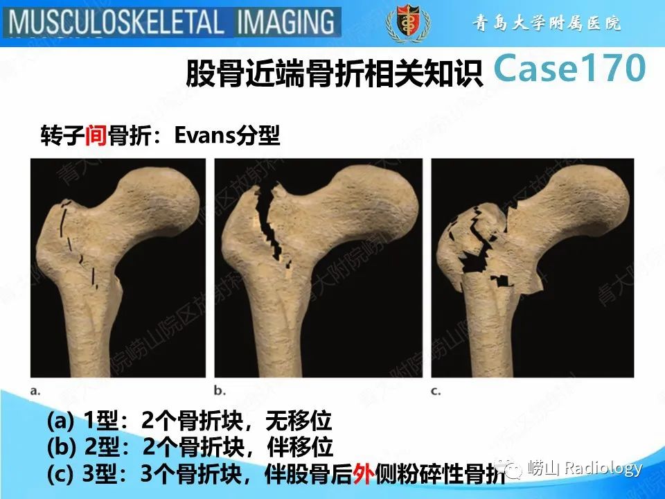 【PPT】股骨术后并发症-22