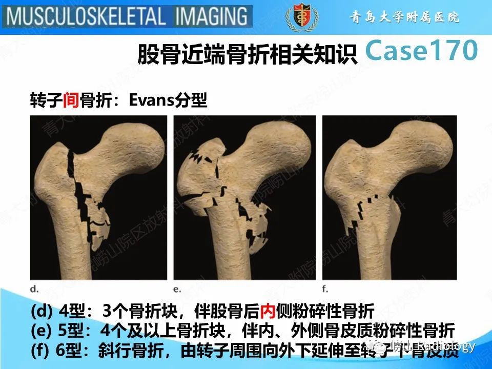 【PPT】股骨术后并发症-23