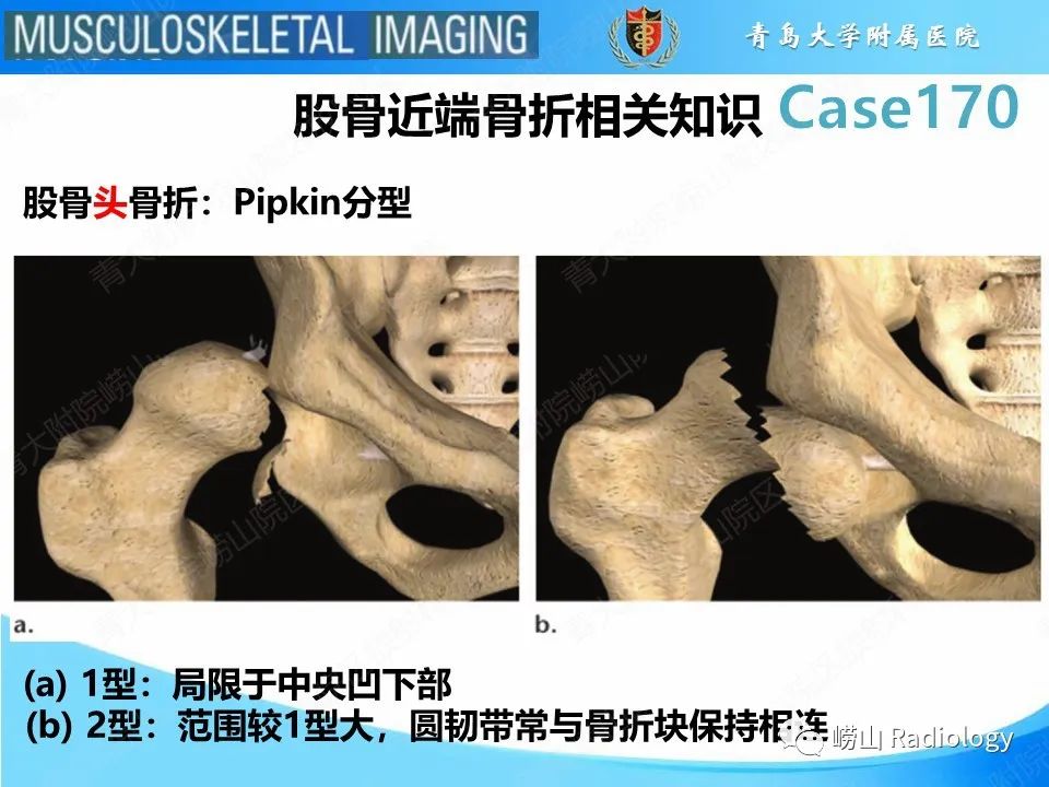 【PPT】股骨术后并发症-3
