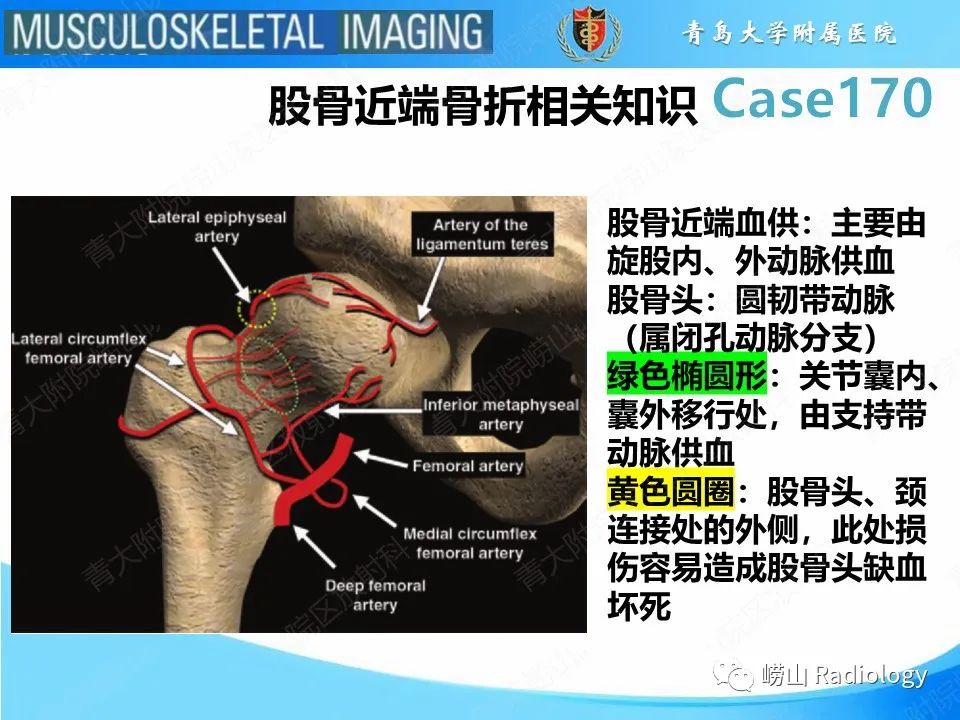 【PPT】股骨术后并发症-17