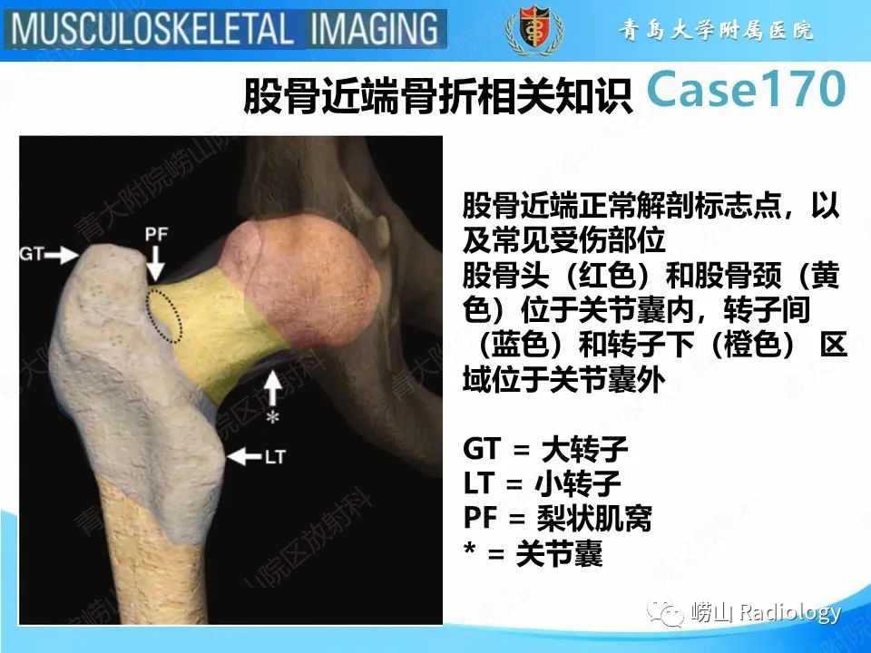 【PPT】股骨术后并发症-2