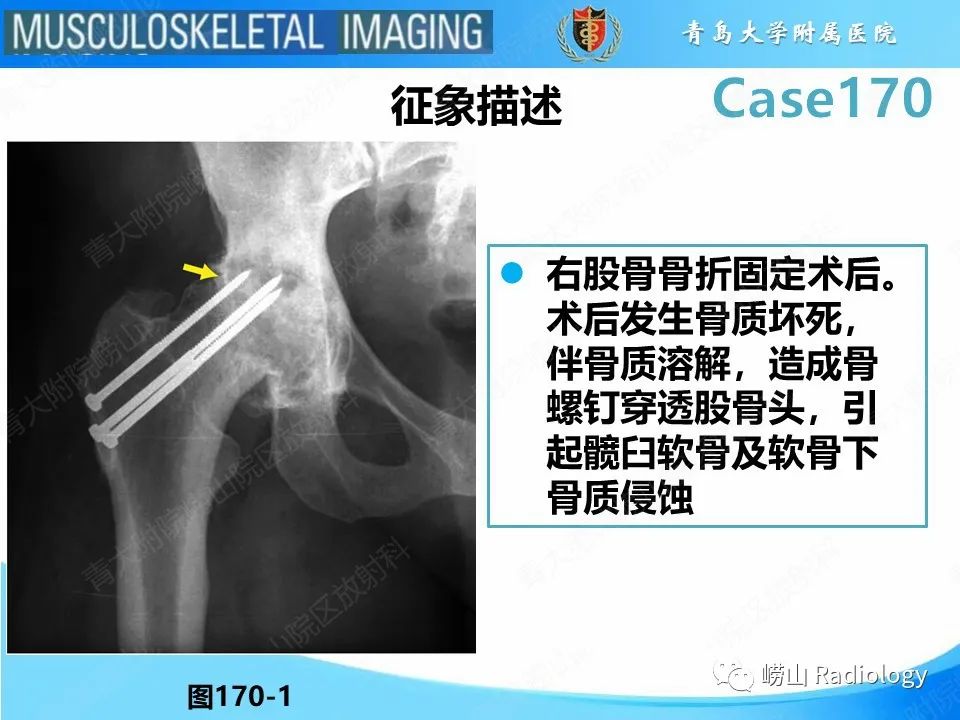 【PPT】股骨术后并发症-11