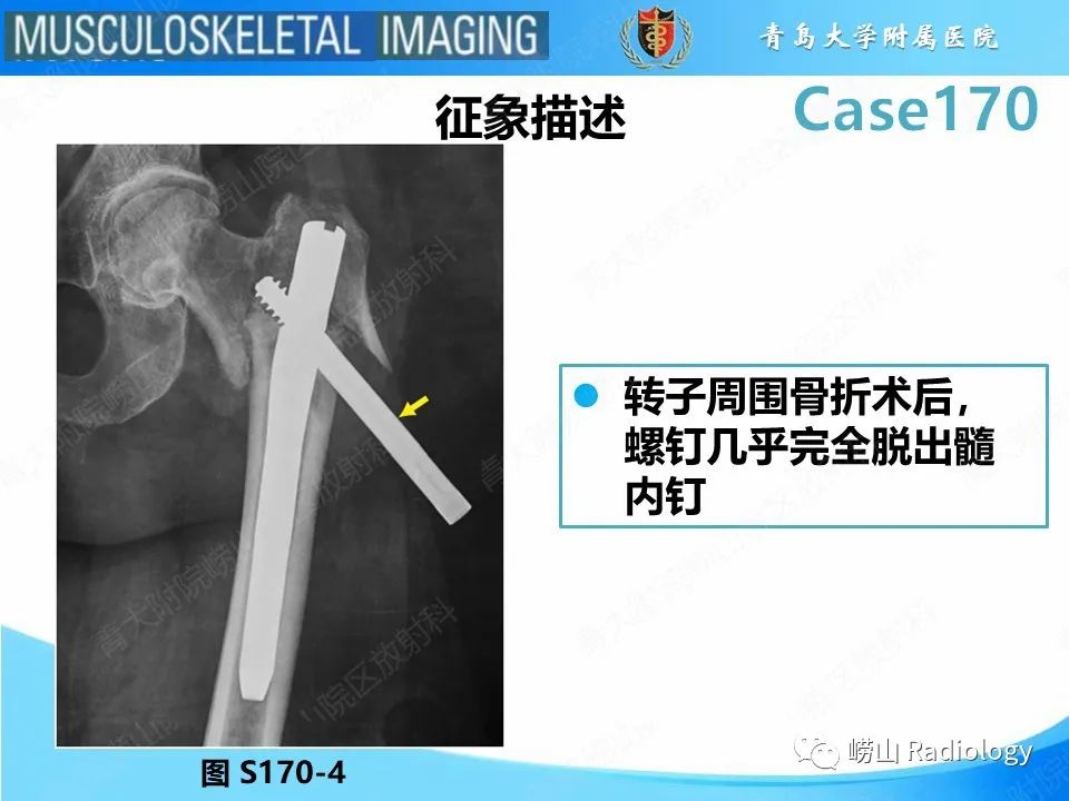 【PPT】股骨术后并发症-14