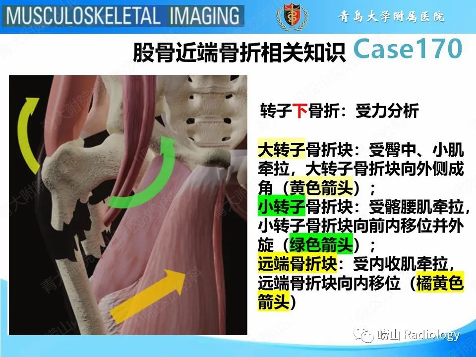 【PPT】股骨术后并发症-25