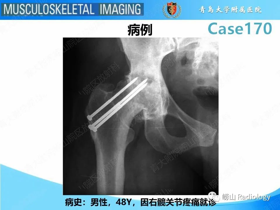 【PPT】股骨术后并发症-2