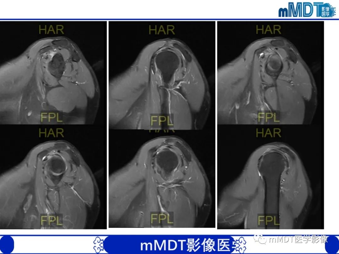【PPT】肩关节撞击综合征-88