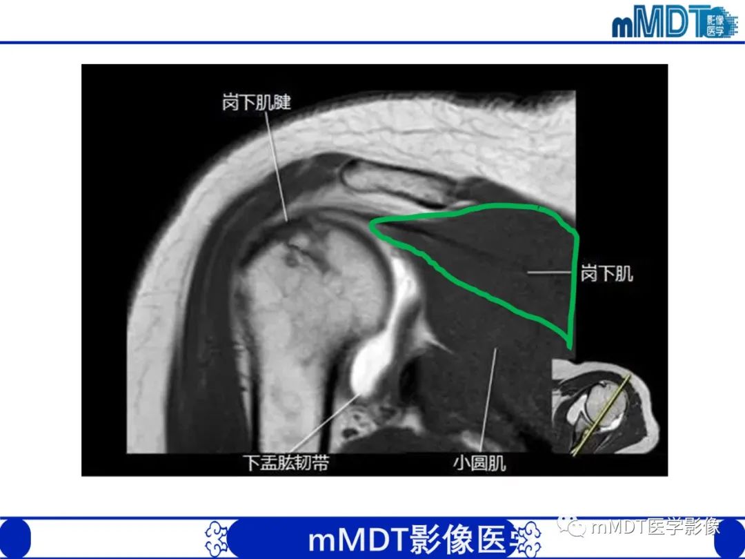 【PPT】肩关节撞击综合征-28