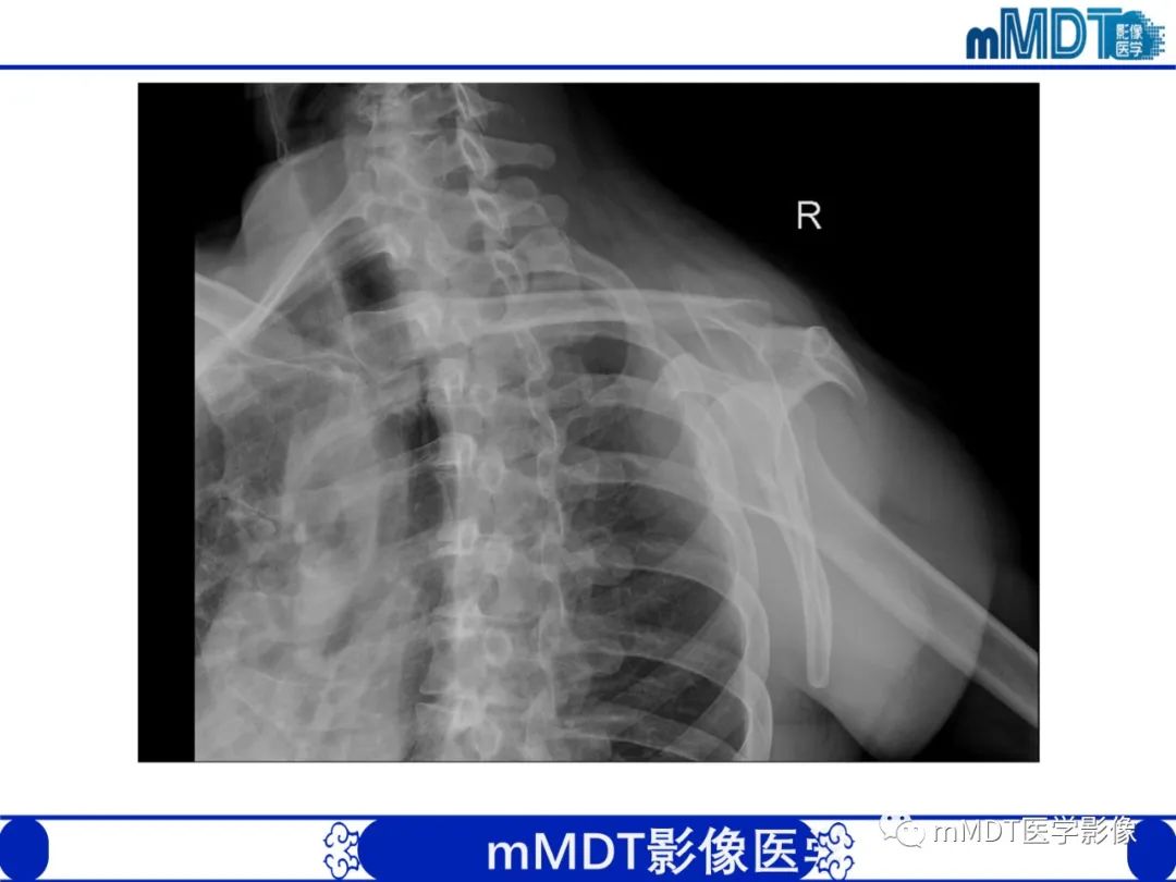 【PPT】肩关节撞击综合征-11