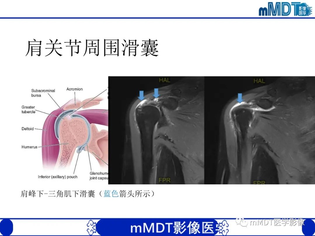 【PPT】肩关节撞击综合征-37
