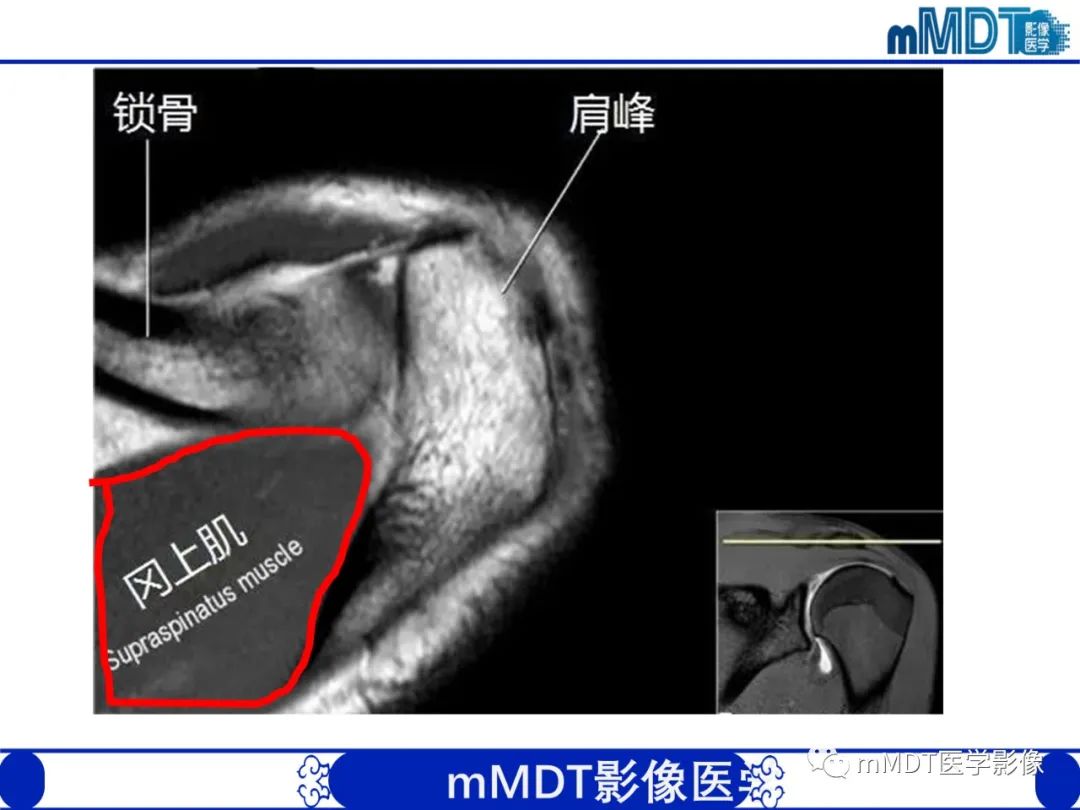 【PPT】肩关节撞击综合征-20