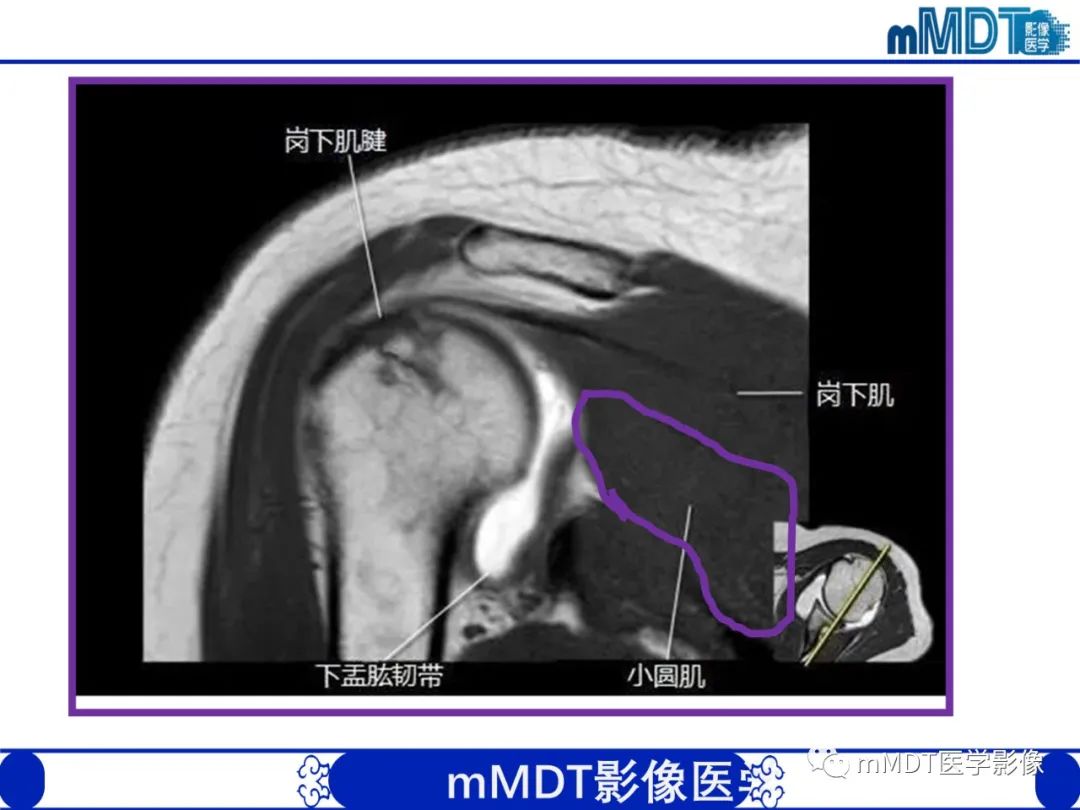 【PPT】肩关节撞击综合征-30