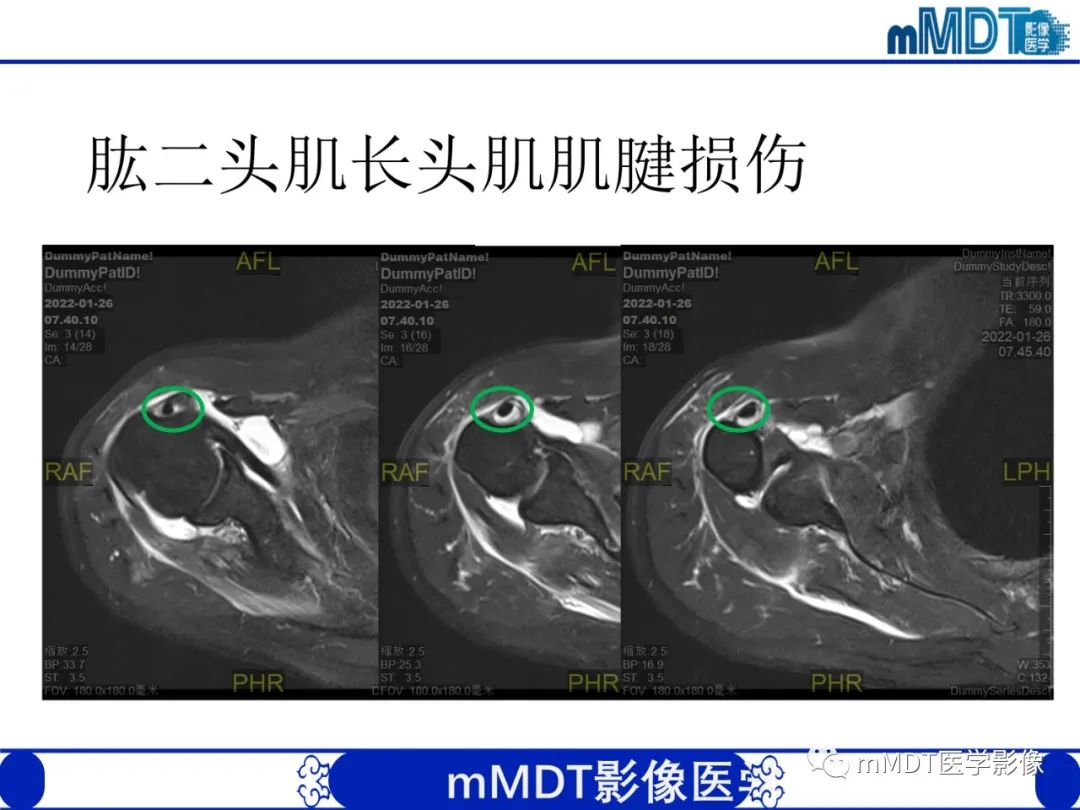 【PPT】肩关节撞击综合征-64