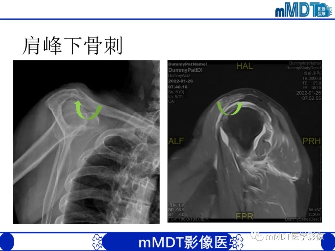 【PPT】肩关节撞击综合征-53