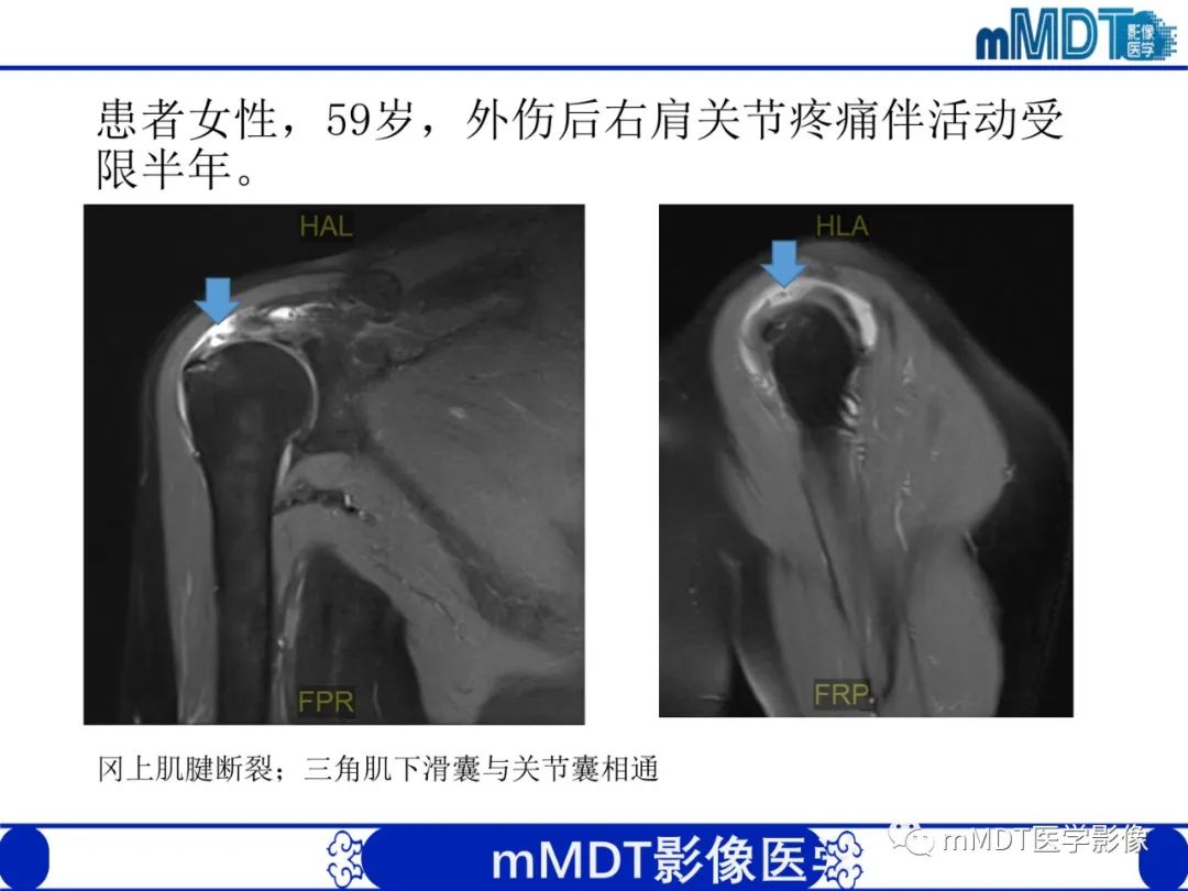 【PPT】肩关节撞击综合征-75