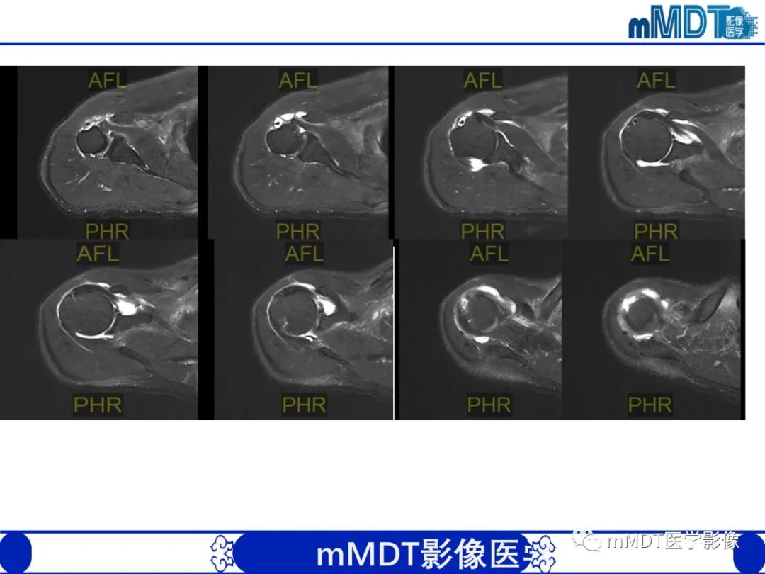 【PPT】肩关节撞击综合征-80