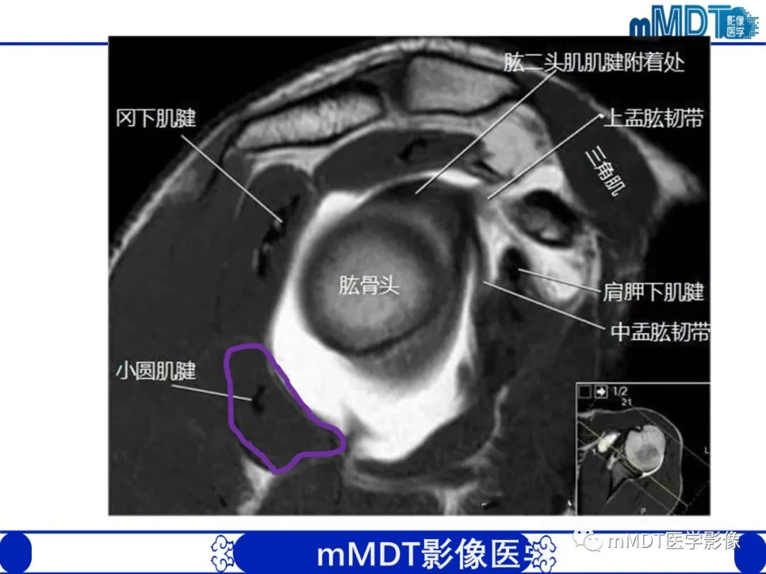 【PPT】肩关节撞击综合征-31