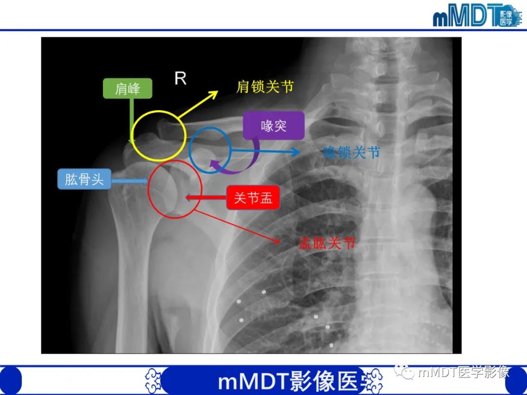 【PPT】肩关节撞击综合征-10