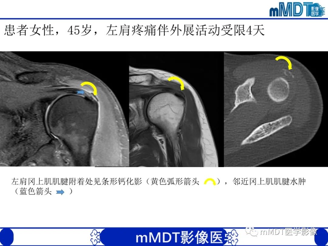 【PPT】肩关节撞击综合征-70