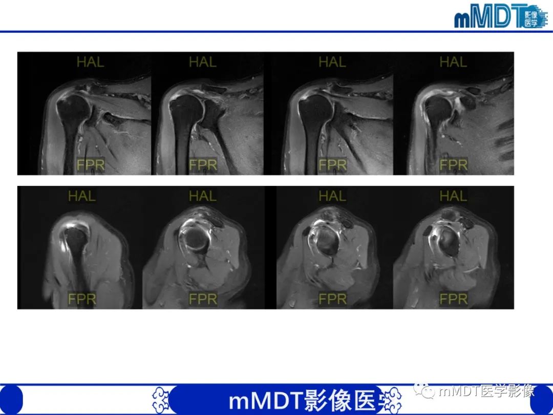 【PPT】肩关节撞击综合征-79