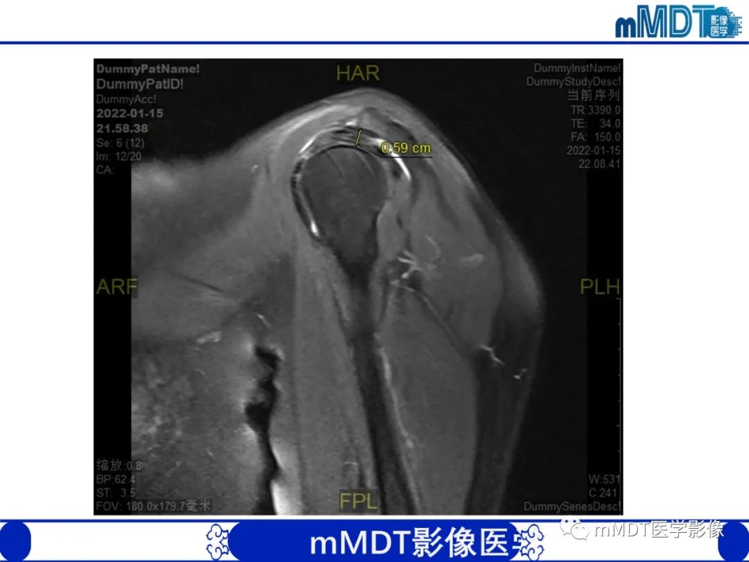 【PPT】肩关节撞击综合征-60