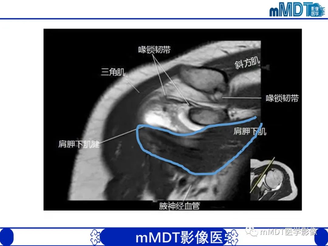 【PPT】肩关节撞击综合征-33