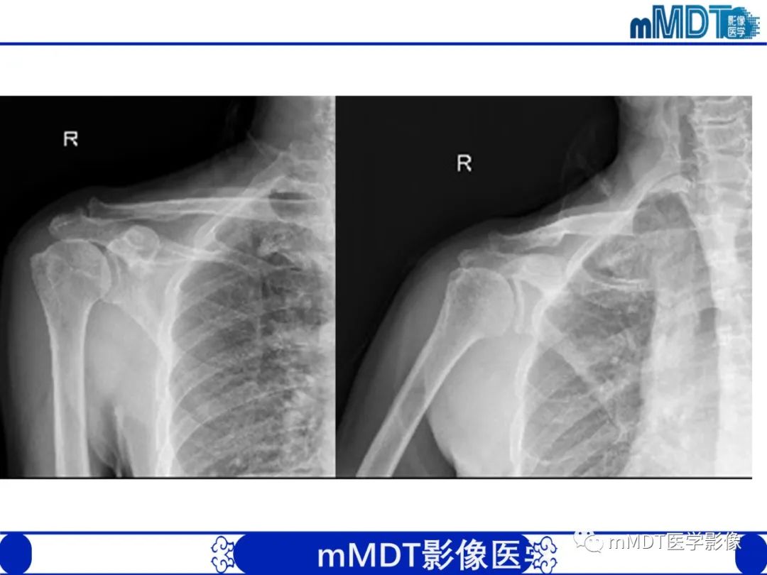 【PPT】肩关节撞击综合征-78
