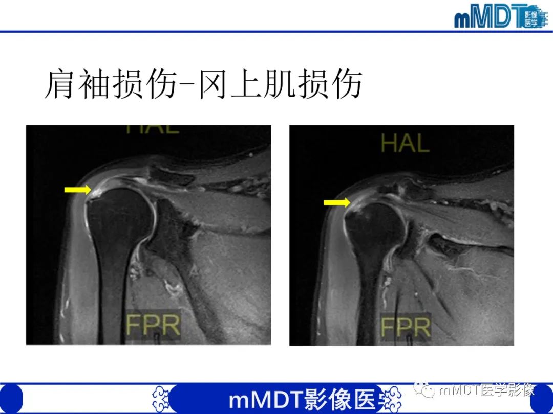 【PPT】肩关节撞击综合征-62