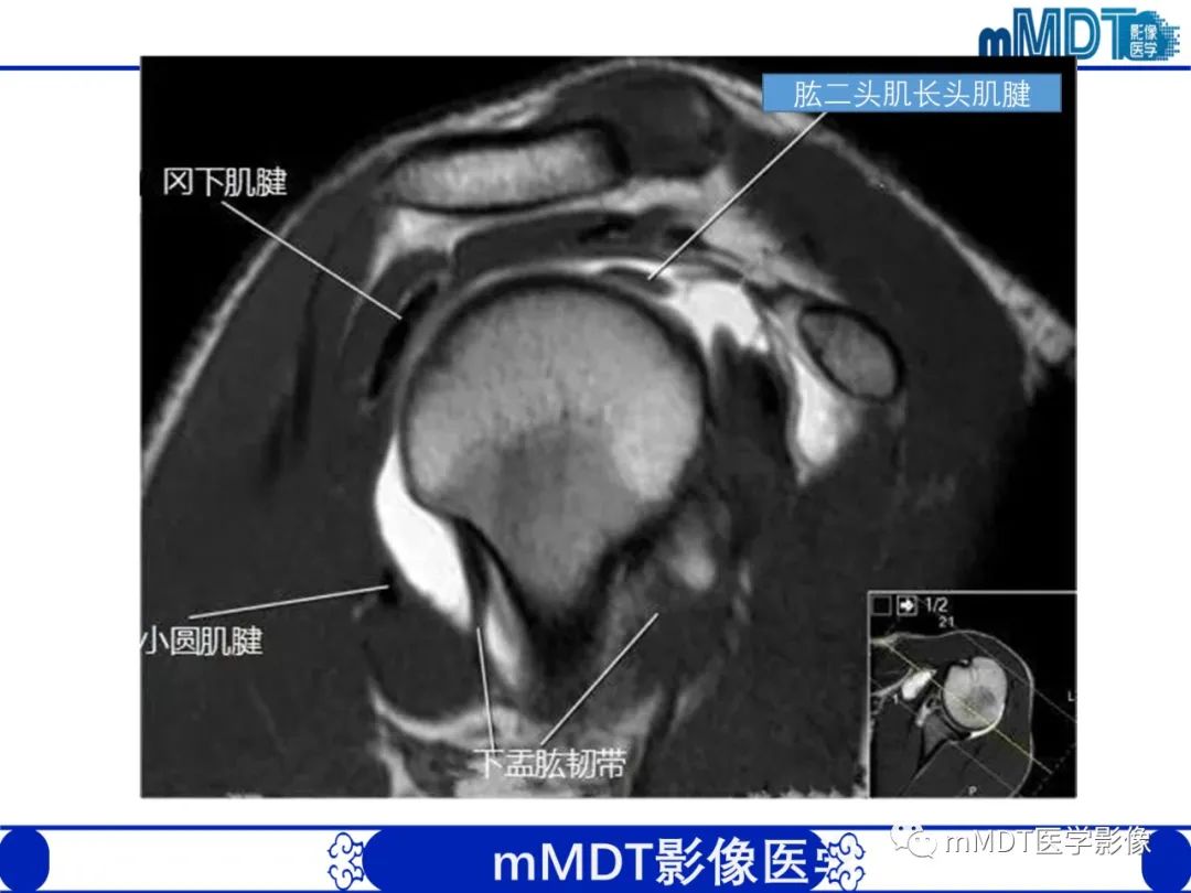 【PPT】肩关节撞击综合征-36