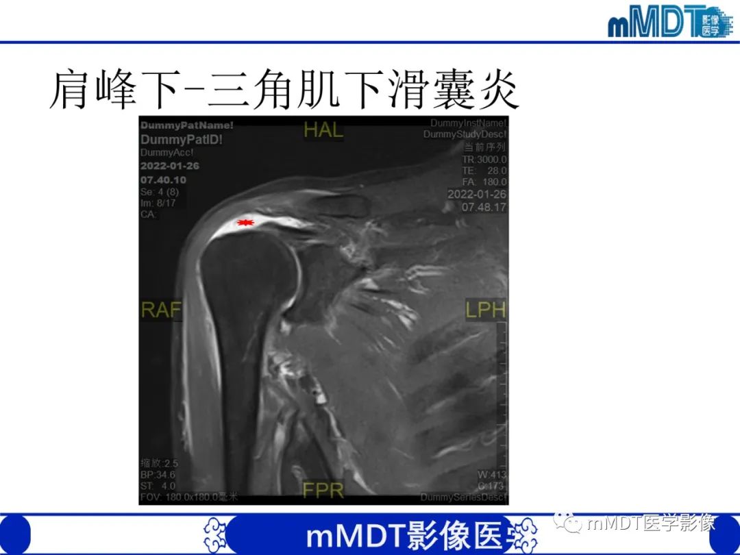 【PPT】肩关节撞击综合征-63