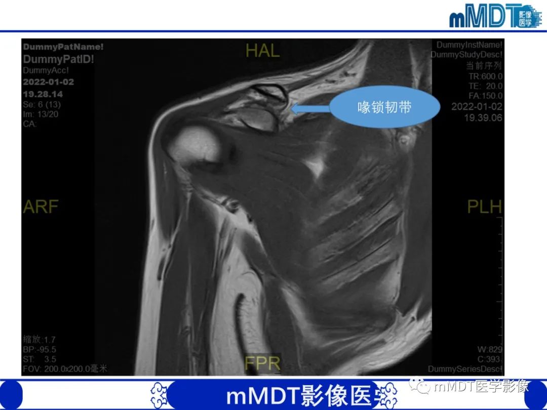 【PPT】肩关节撞击综合征-16