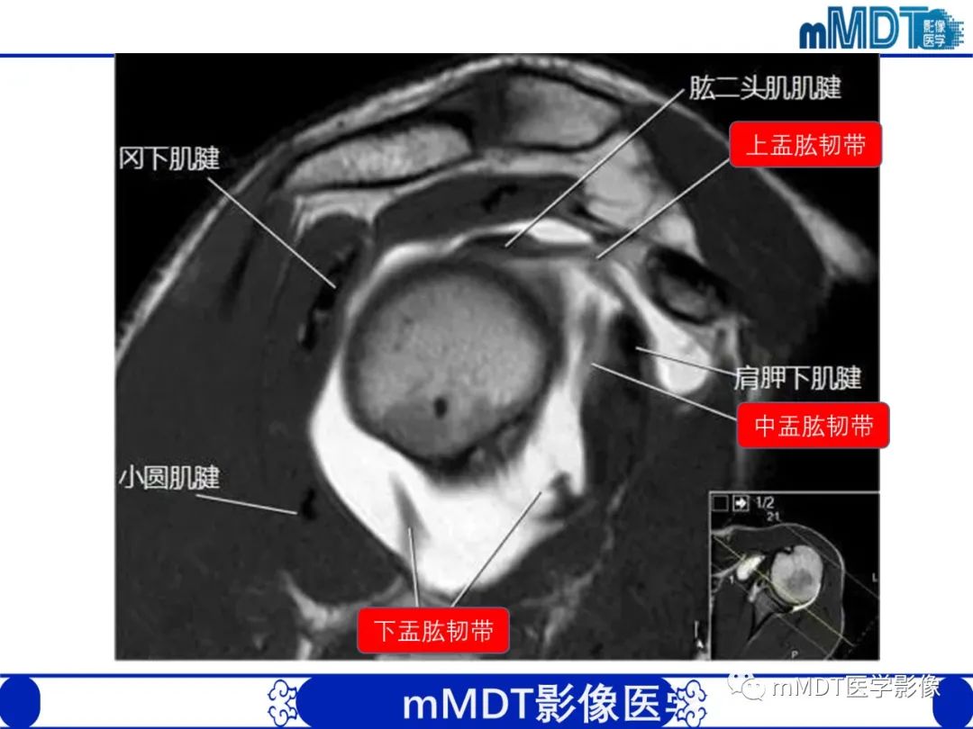 【PPT】肩关节撞击综合征-17