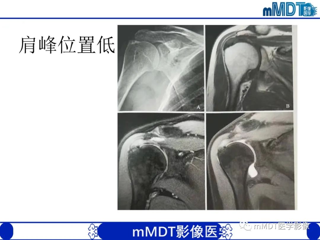 【PPT】肩关节撞击综合征-52
