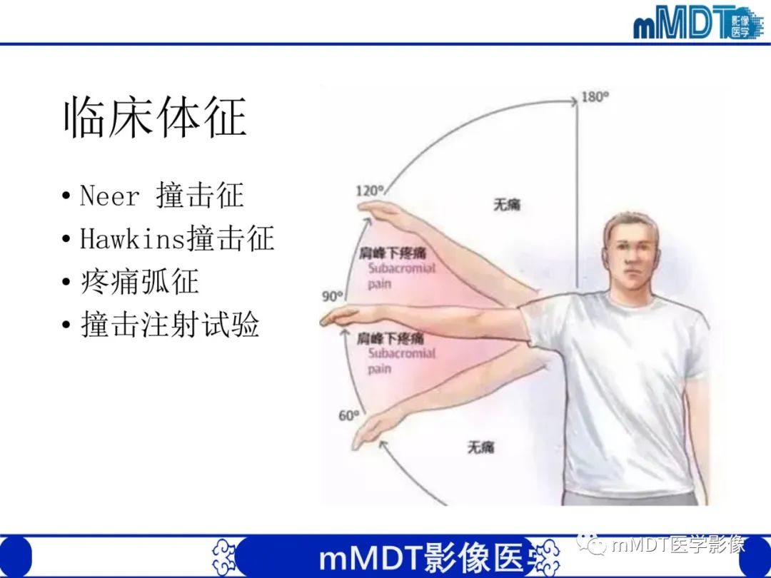 【PPT】肩关节撞击综合征-45
