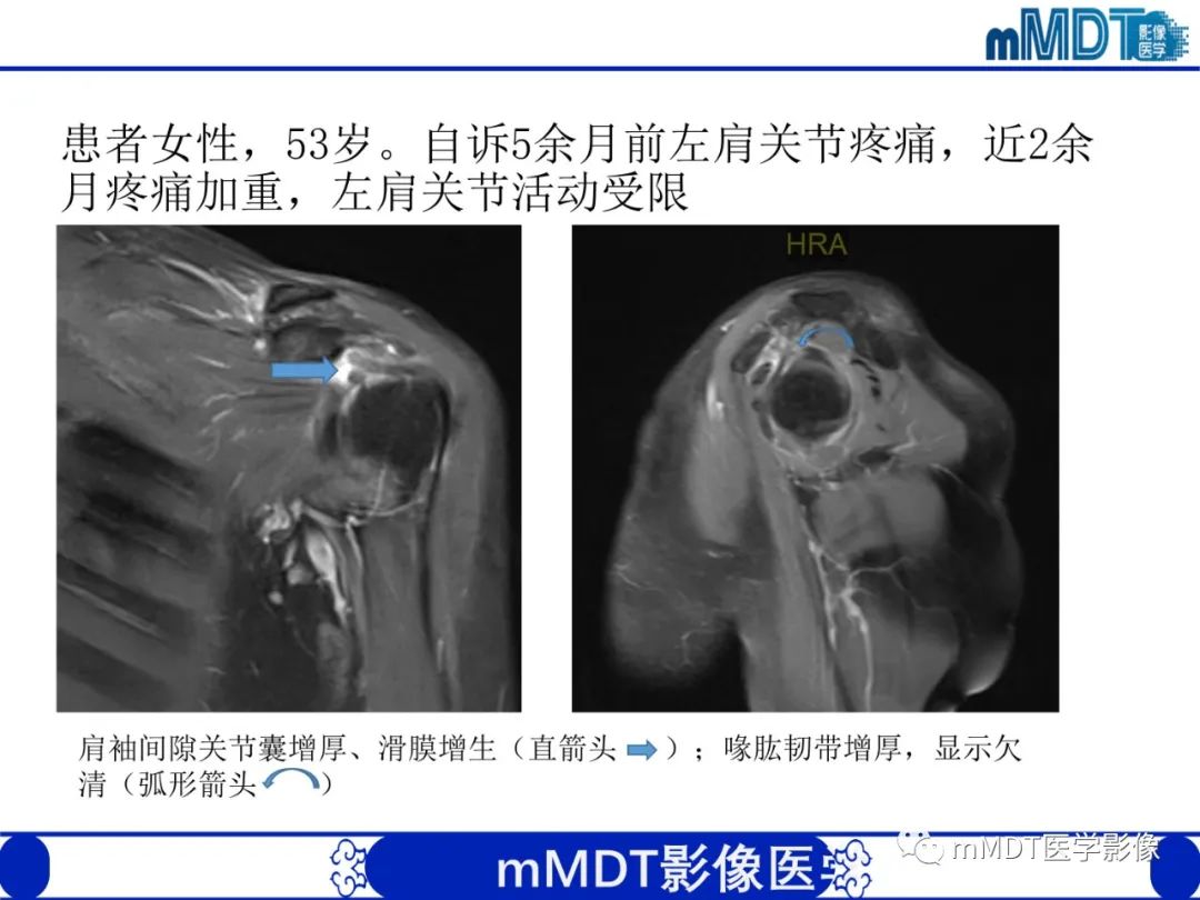 【PPT】肩关节撞击综合征-72