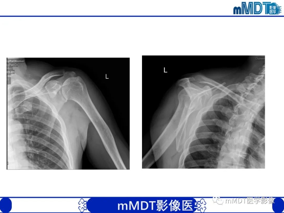 【PPT】肩关节撞击综合征-85