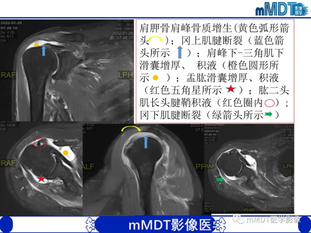【PPT】肩关节撞击综合征-5
