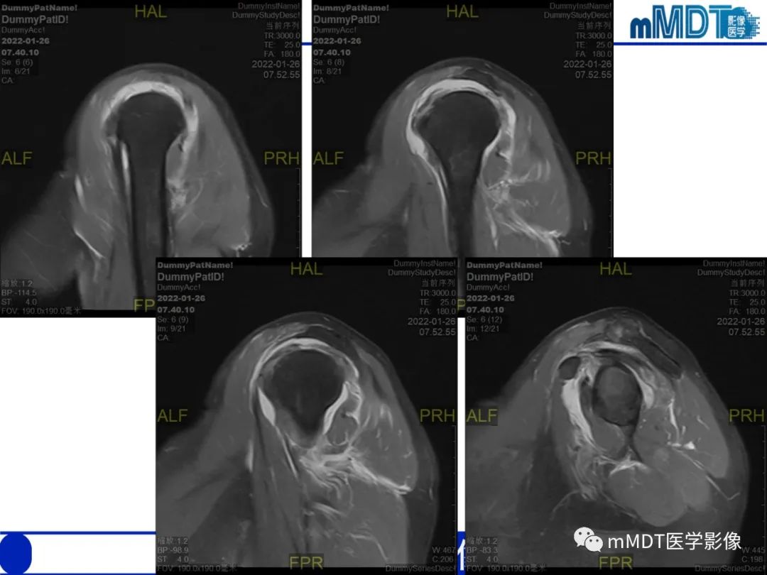 【PPT】肩关节撞击综合征-4