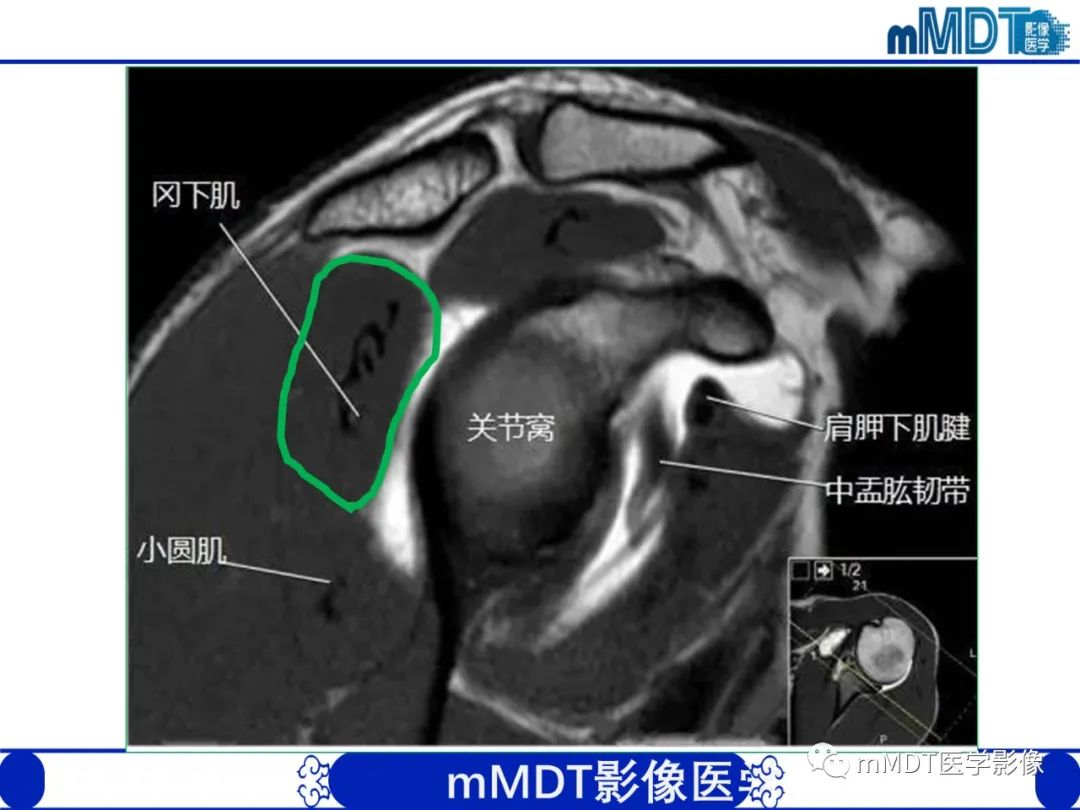 【PPT】肩关节撞击综合征-25