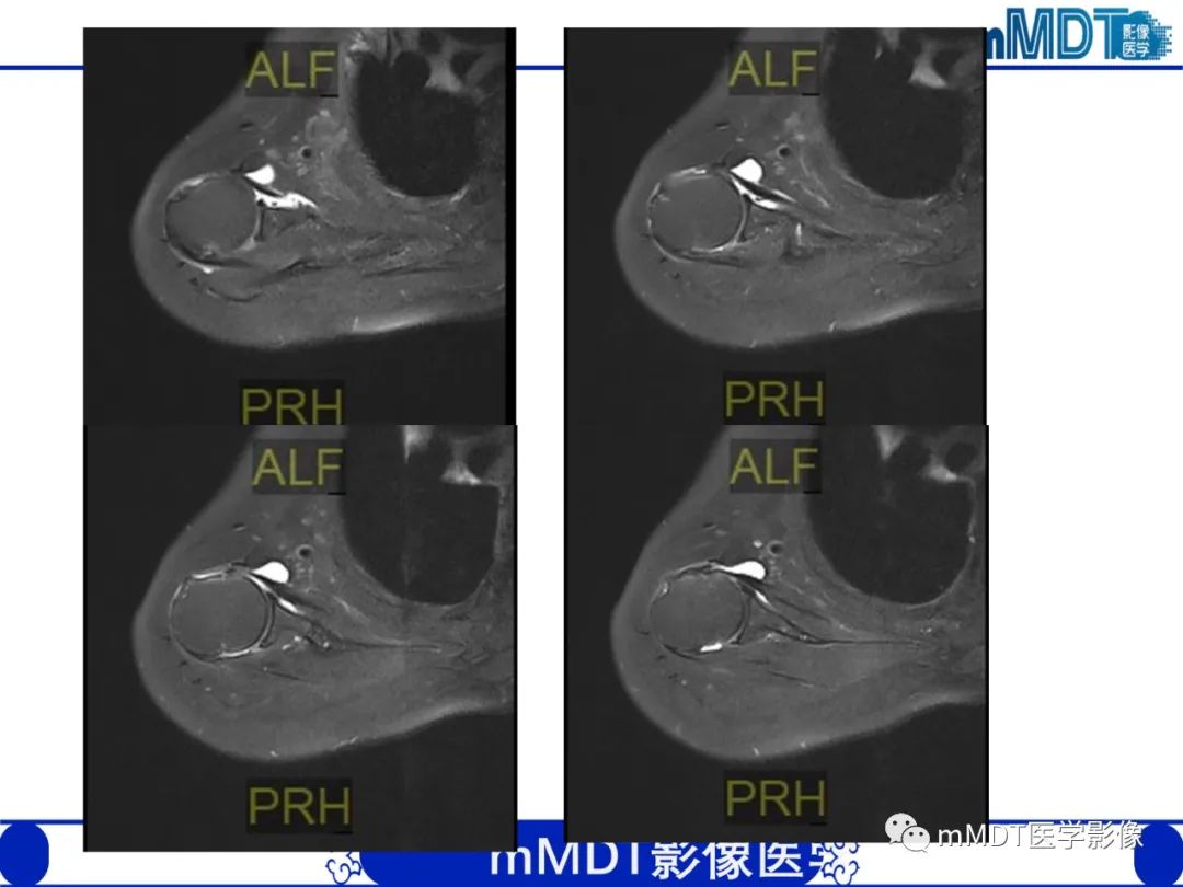 【PPT】肩关节撞击综合征-96