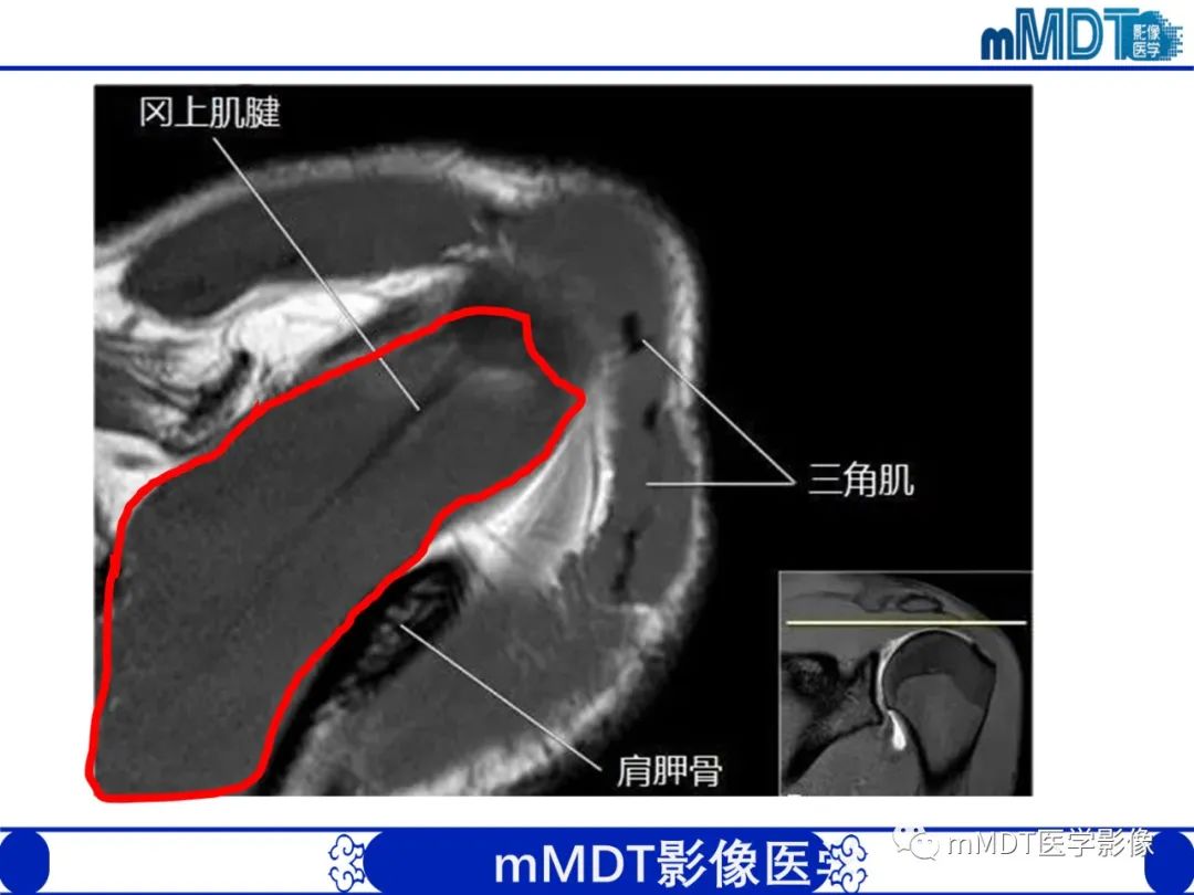 【PPT】肩关节撞击综合征-21