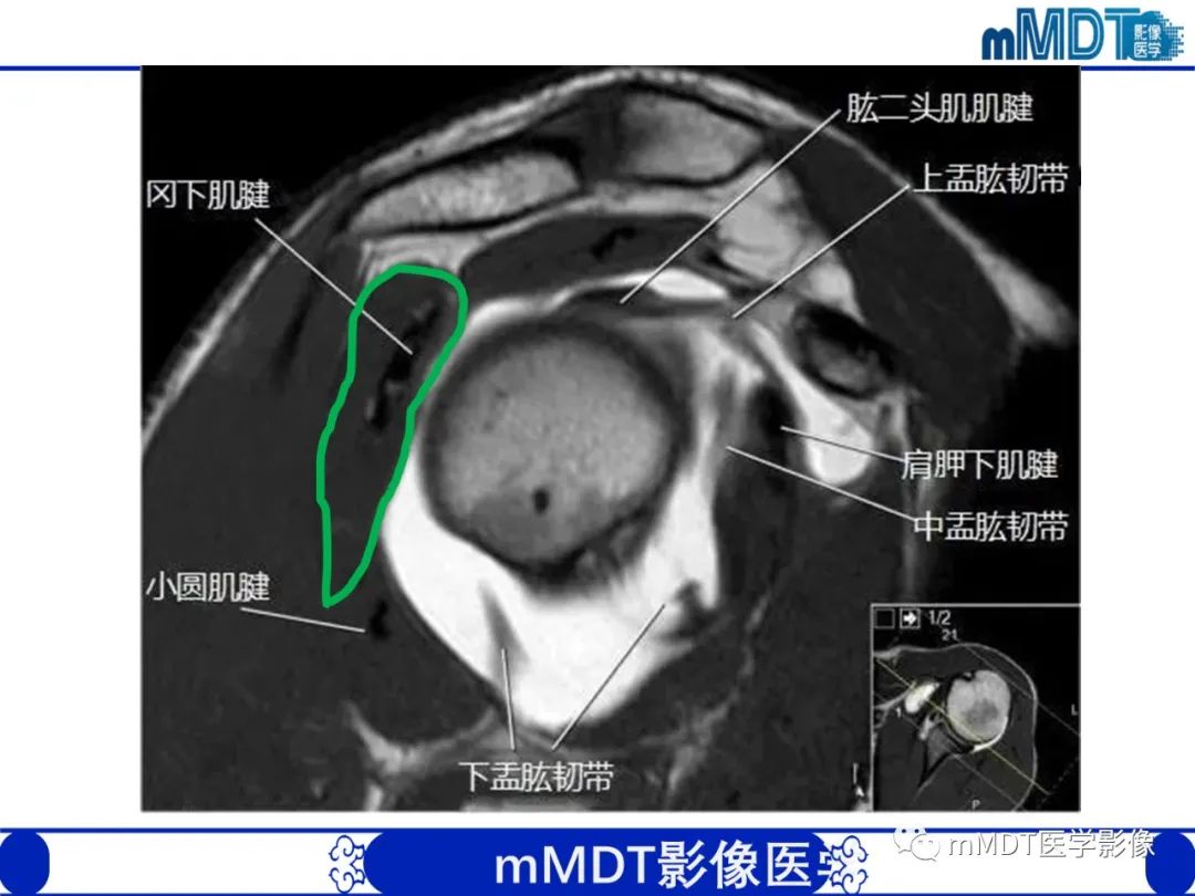 【PPT】肩关节撞击综合征-26