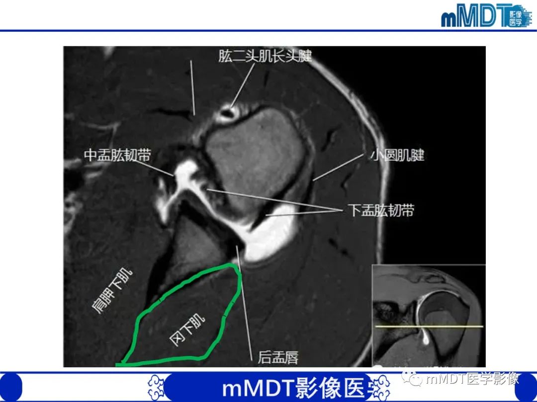 【PPT】肩关节撞击综合征-27