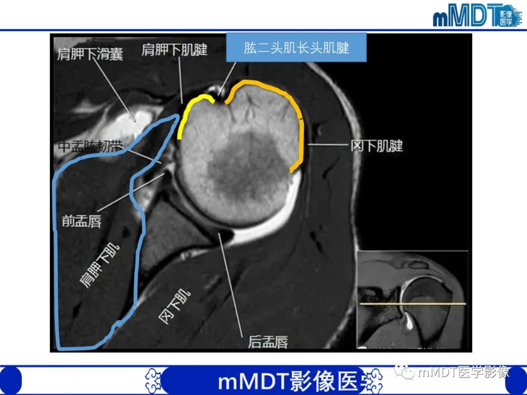 【PPT】肩关节撞击综合征-34