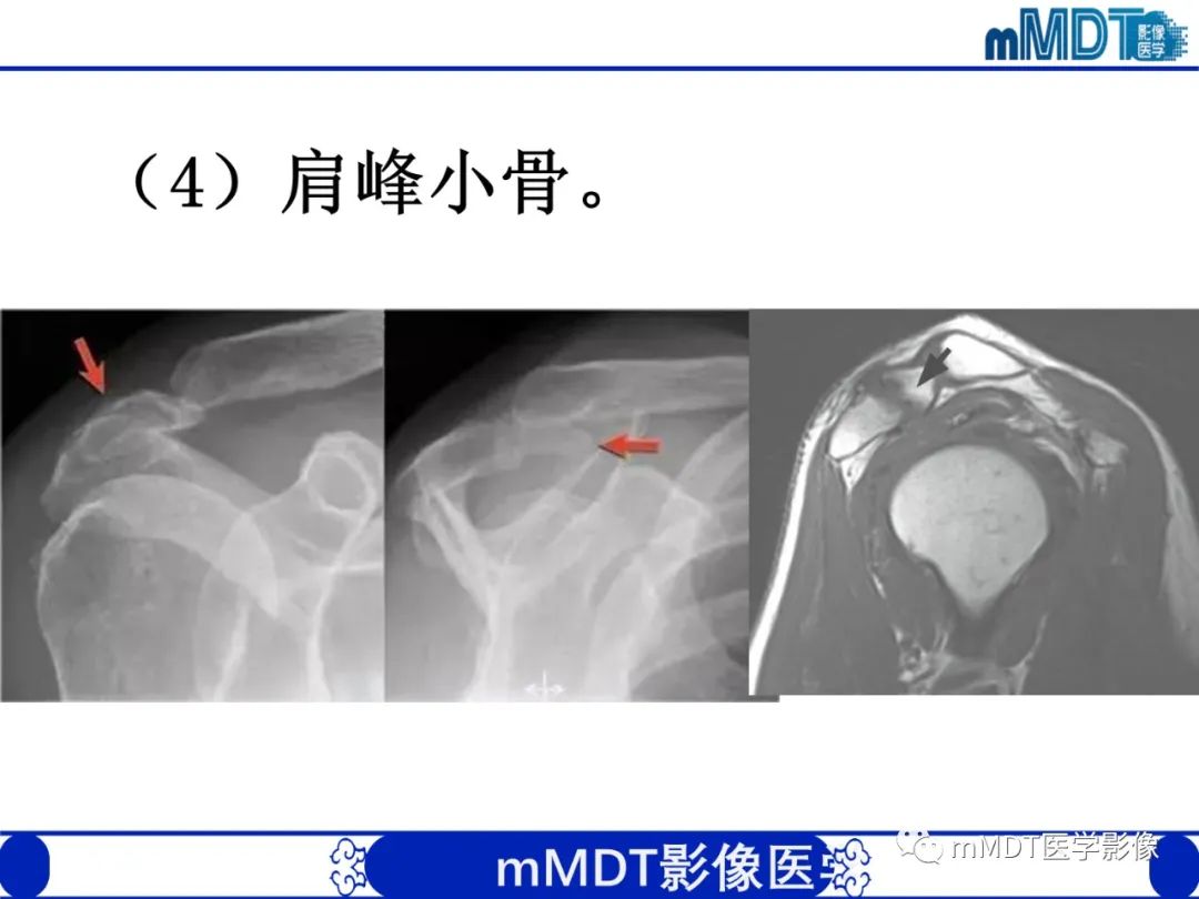 【PPT】肩关节撞击综合征-58