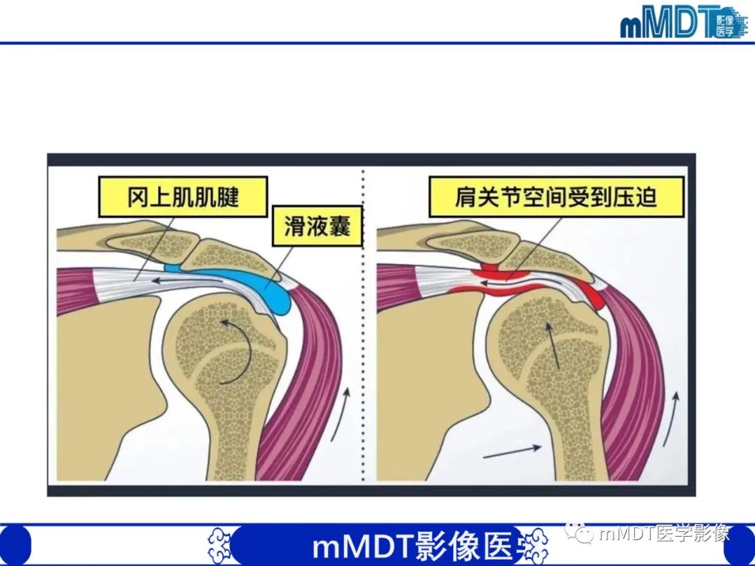 【PPT】肩关节撞击综合征-41