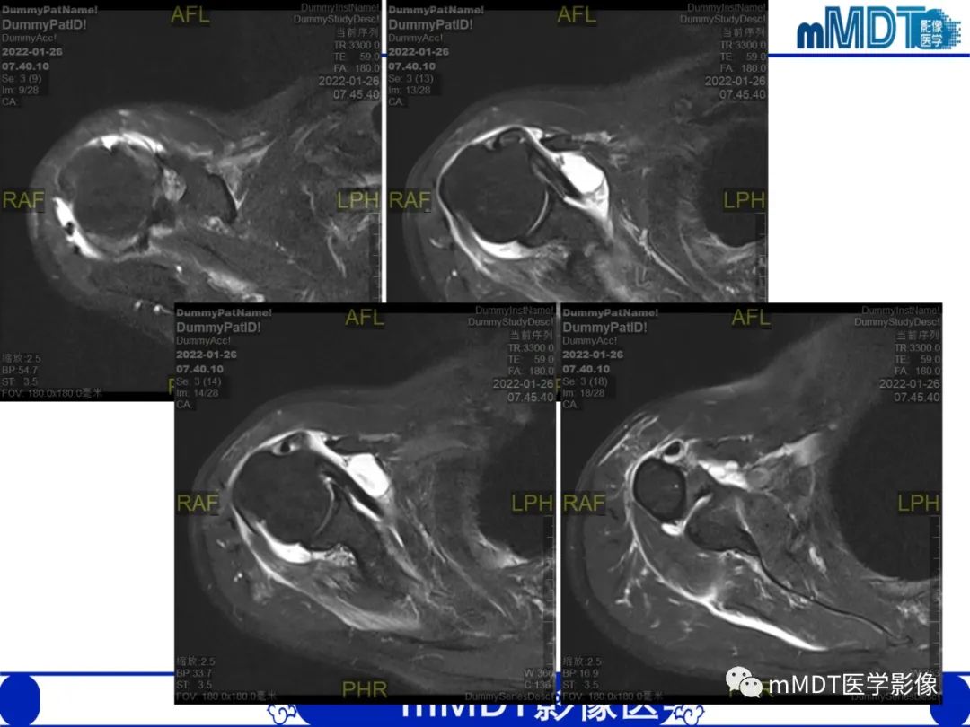 【PPT】肩关节撞击综合征-3
