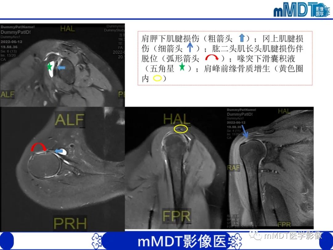【PPT】肩关节撞击综合征-97