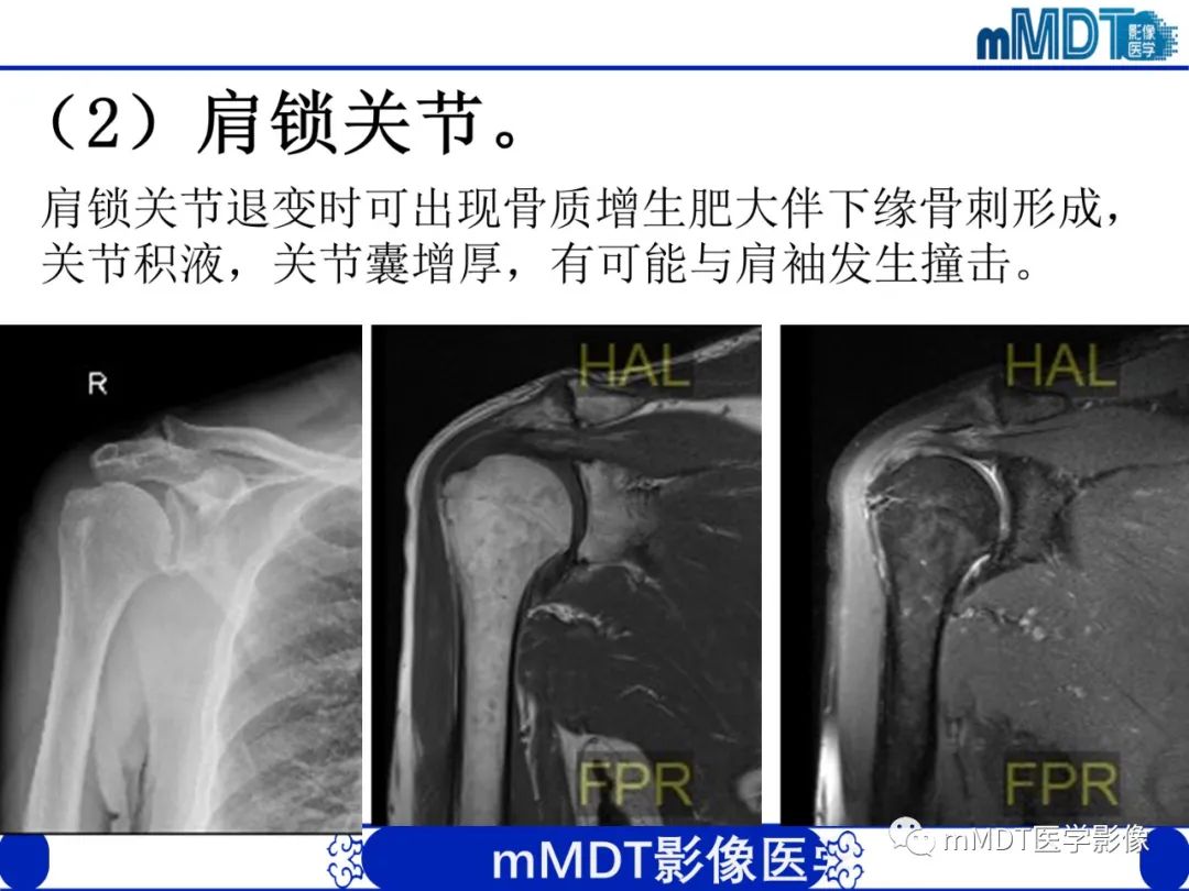 【PPT】肩关节撞击综合征-54