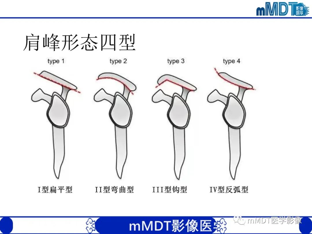【PPT】肩关节撞击综合征-49