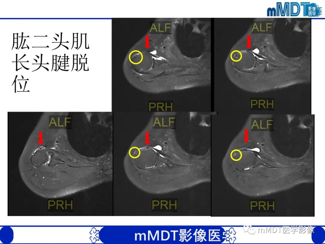 【PPT】肩关节撞击综合征-65